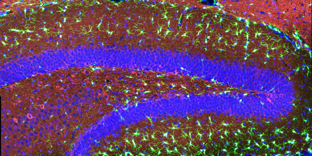Cómo una mutación en la microglía eleva el riesgo de Alzheimer |  Noticias del MIT