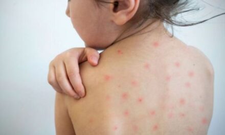 El Ministerio de Salud confirma un caso de sarampión |  En un niño de 19 meses que no fue vacunado contra la enfermedad